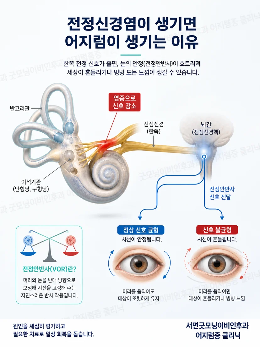 한쪽 전정기능 저하 후 뇌가 균형 정보를 다시 조정하는 원리를 나타낸 그림