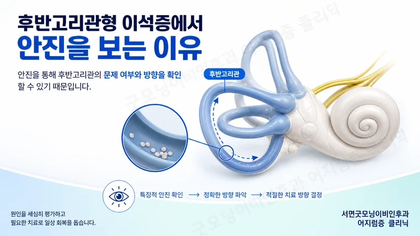 후반고리관형 이석증에서 안진을 관찰하는 이유를 설명하는 핵심 도식