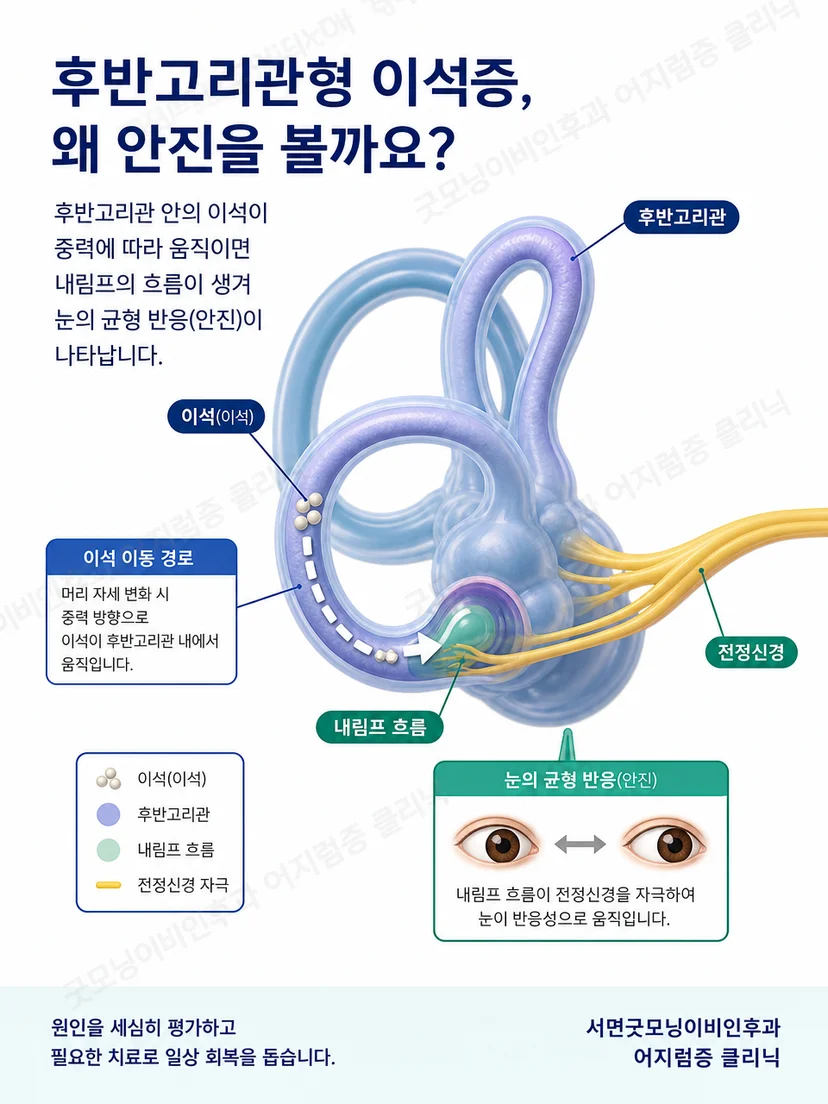 후반고리관의 위치와 이석 이동 경로를 단순화한 해부 도식
