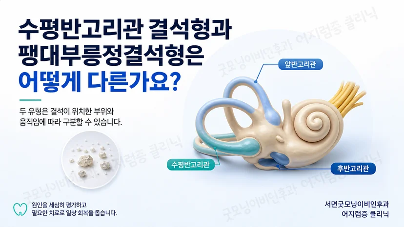 수평반고리관 결석형과 팽대부릉정결석형의 핵심 차이 도식