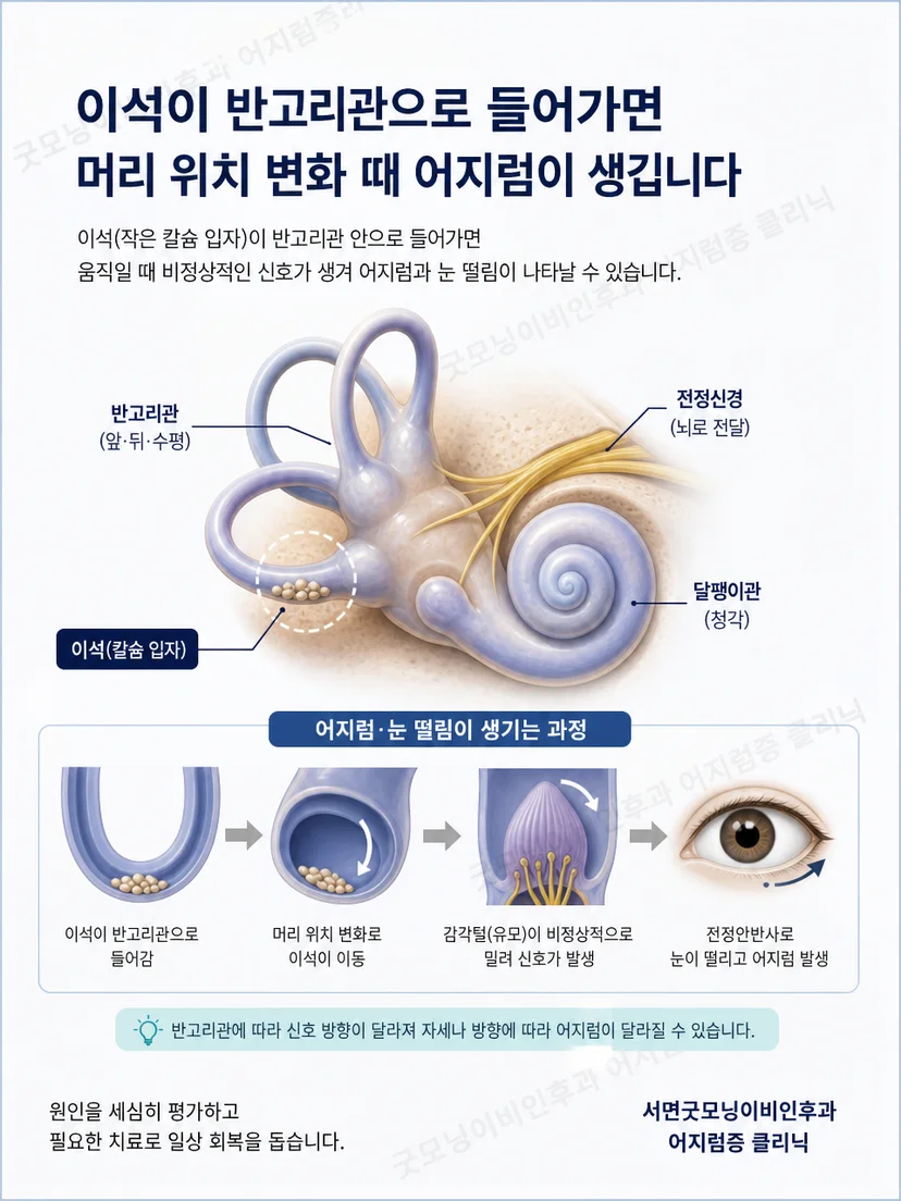 앞·뒤·수평반고리관의 공간 방향과 이석 이동 원리 3차원 도식