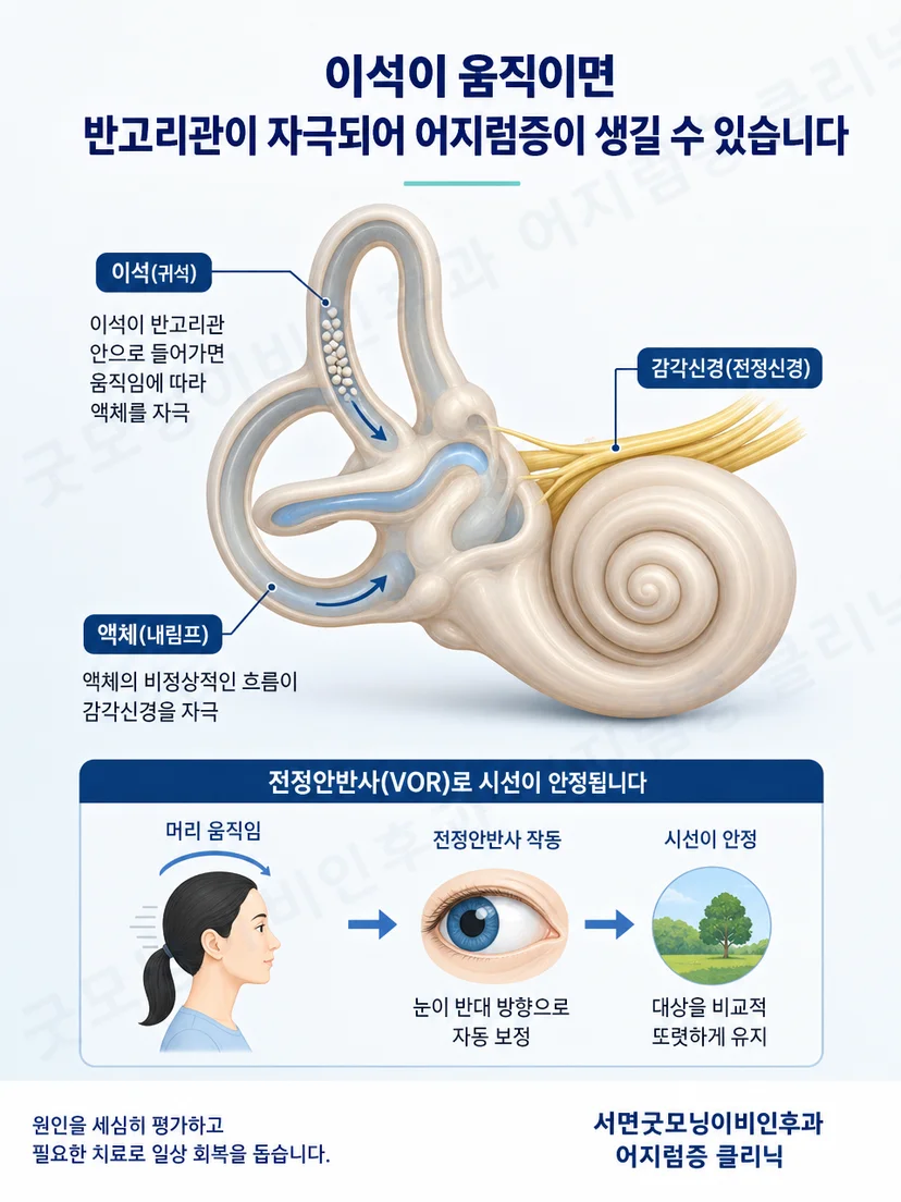머리 위치 변화와 이석증 회전성 어지럼의 관계를 설명하는 그림