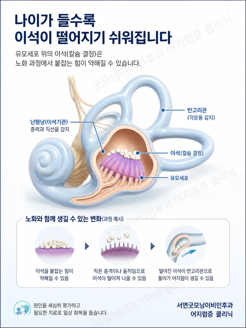 내이의 이석 기관과 반고리관에서 위치성 어지럼이 생기는 원리