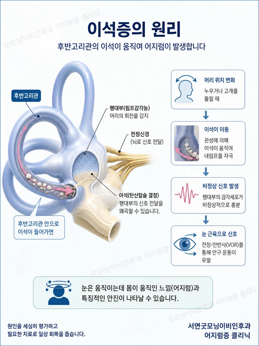 양쪽 후반고리관과 이석 이동 경로를 설명하는 해부 도식