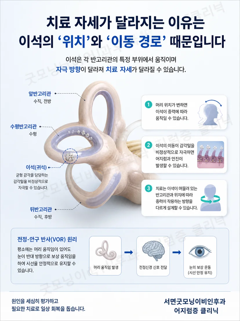 앞 뒤 수평반고리관의 서로 다른 공간 방향을 보여주는 삼차원 내이 도식