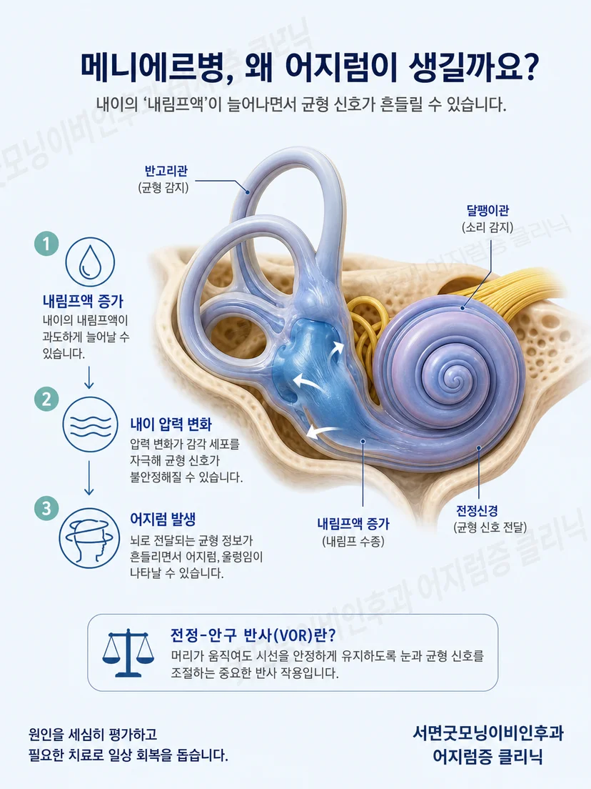 내이의 체액 균형과 메니에르병 생활 관리의 관계를 설명하는 이미지