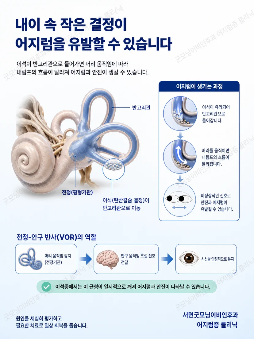 반고리관과 자세 변화에 따른 이석 움직임의 원리를 보여주는 교육 그림