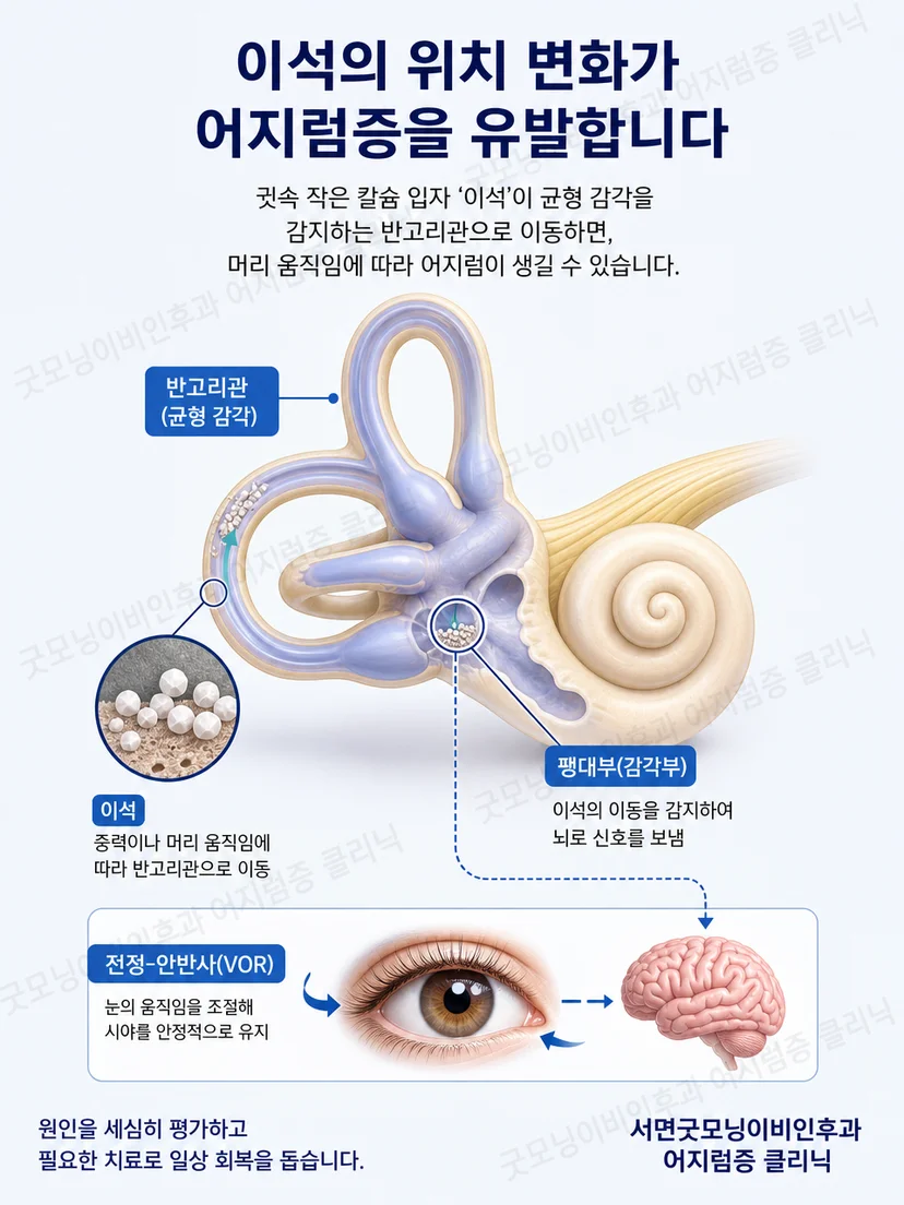 내이의 이석과 골대사 연관 가능성을 보여주는 설명 그림