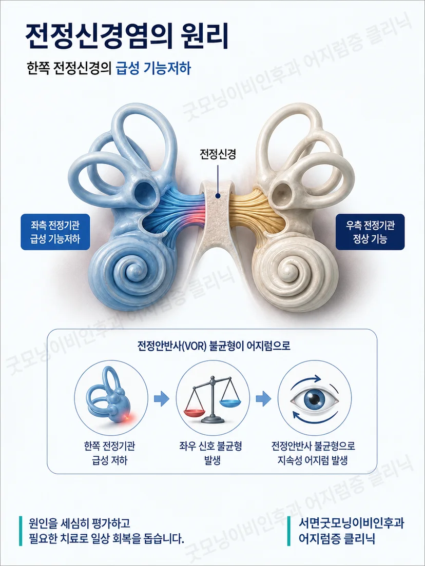 한쪽 전정기능 저하로 좌우 균형 신호가 달라지는 원리