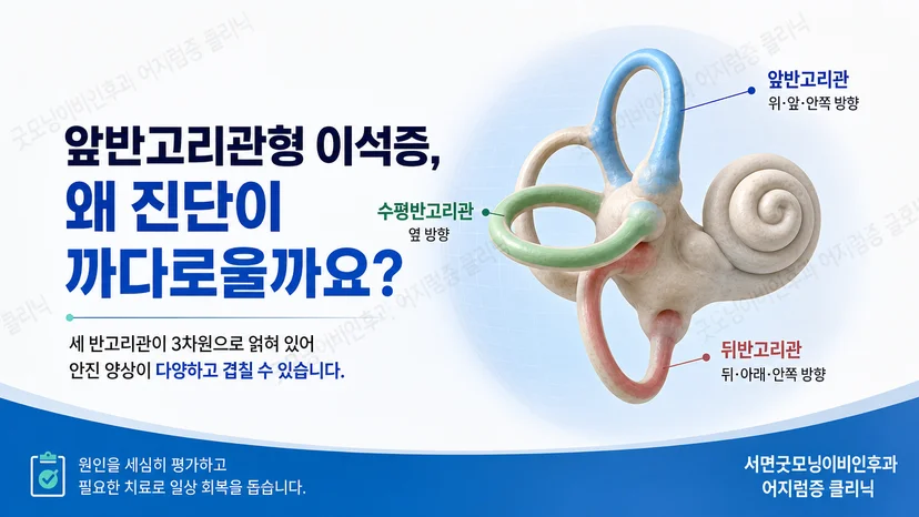 앞반고리관형 이석증 진단이 까다로운 이유를 설명하는 핵심 그림