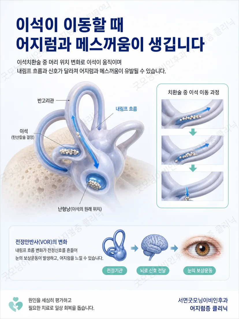 반고리관 안 이석 이동과 평형 신호 자극 원리