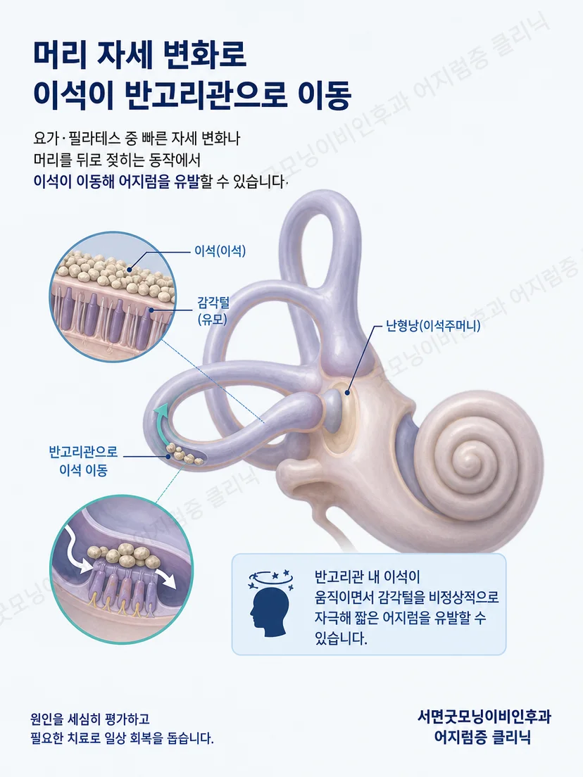 귀 안 평형기관과 머리 움직임에 따른 이석증 발생 원리