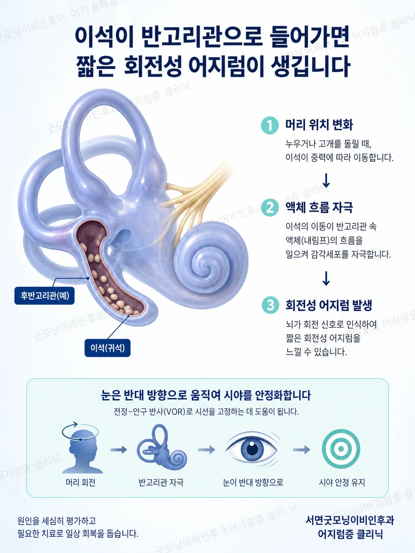 내이 반고리관과 머리 움직임에 따른 이석증 발생 원리