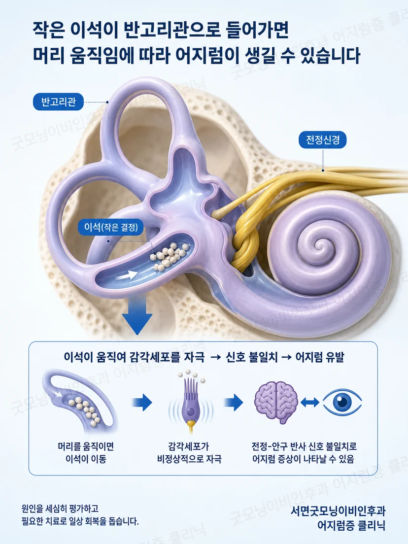 귀의 평형기관과 이석증 발생 원리를 설명하는 그림