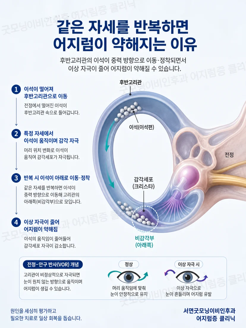 후반고리관 안에서 이석이 이동하며 감각기관을 자극하는 해부 도식