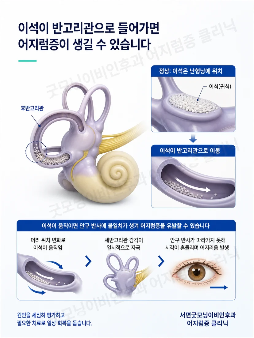 반고리관 내 이석 이동과 자세 변화의 관계를 설명하는 그림