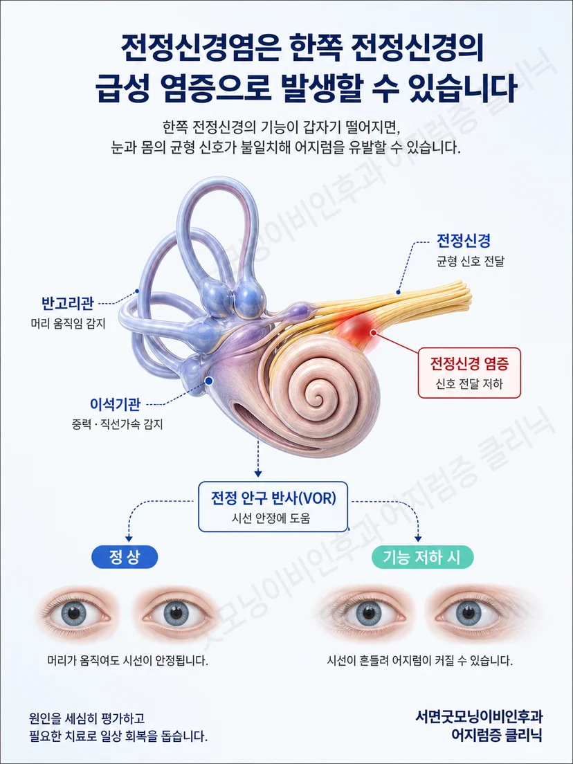 양쪽 전정 신호 불균형이 지속성 어지럼을 만드는 원리