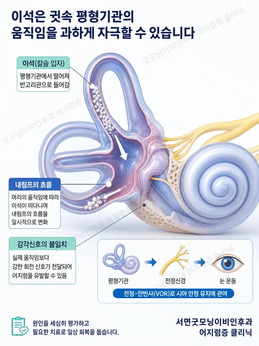 귀 안 평형기관에서 이석이 이동해 자세 어지럼을 유발하는 원리
