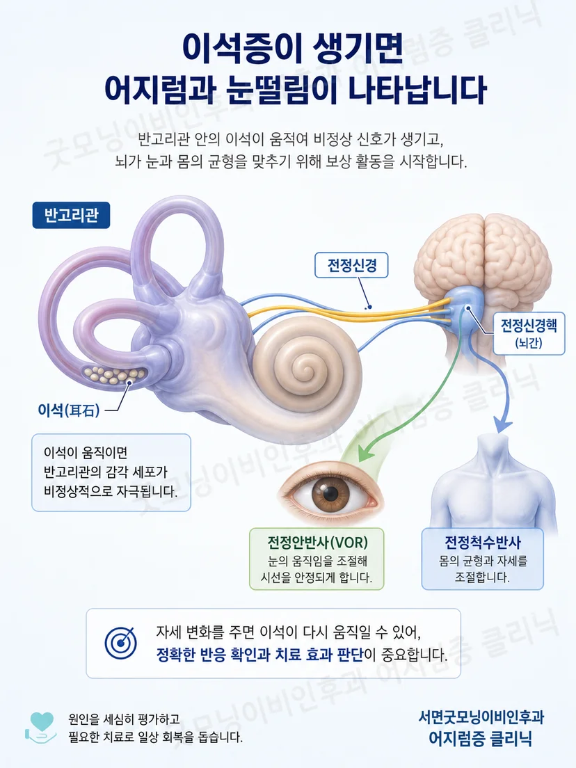 머리 위치 변화와 반고리관 자극으로 자세성 안진이 발생하는 원리