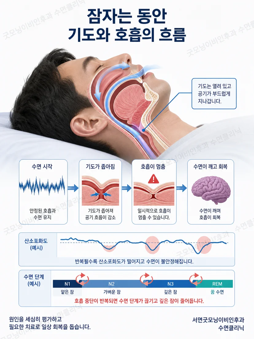 재발성 과다수면과 지속성 졸림 양상을 구분하는 설명 그림