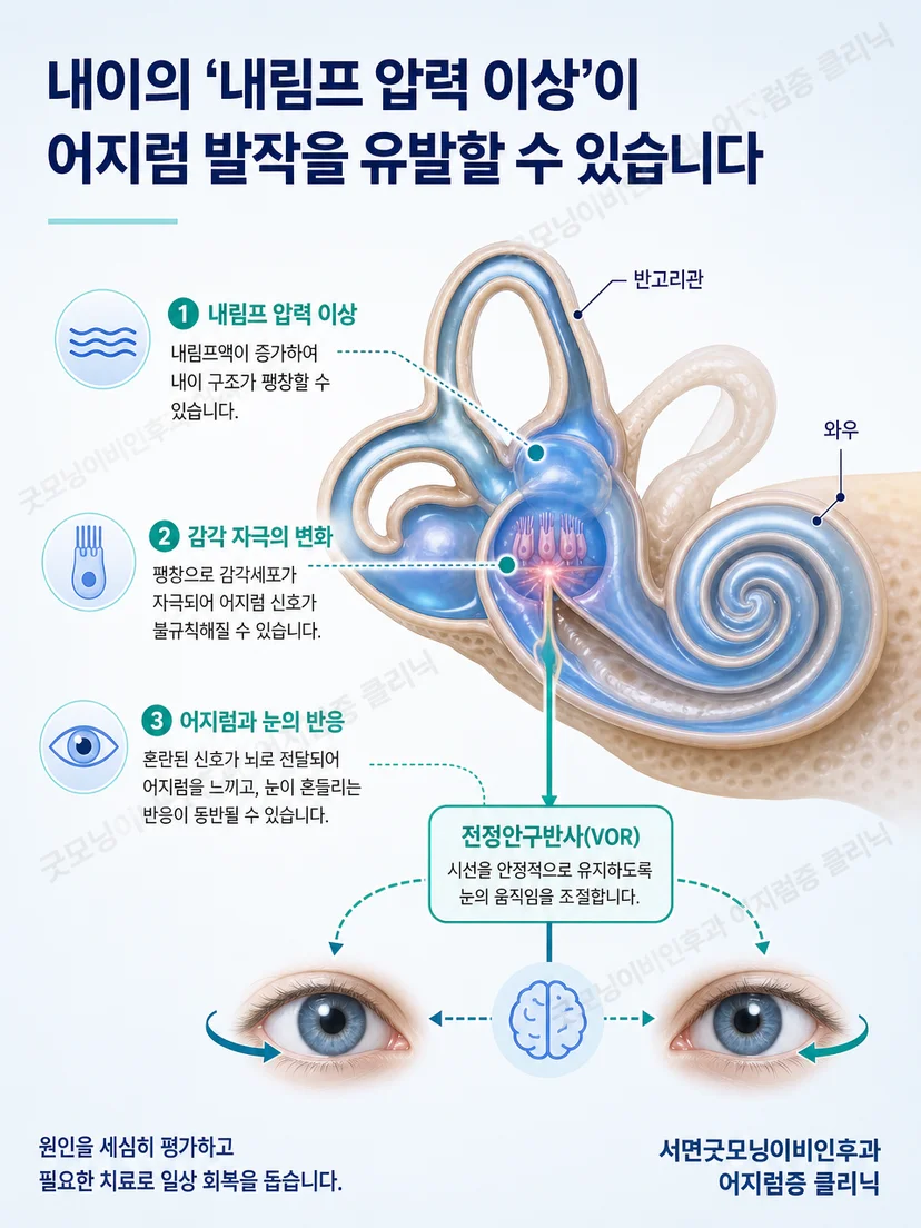 메니에르병에서 내이 증상과 약물치료 목적의 관계를 보여주는 설명 이미지