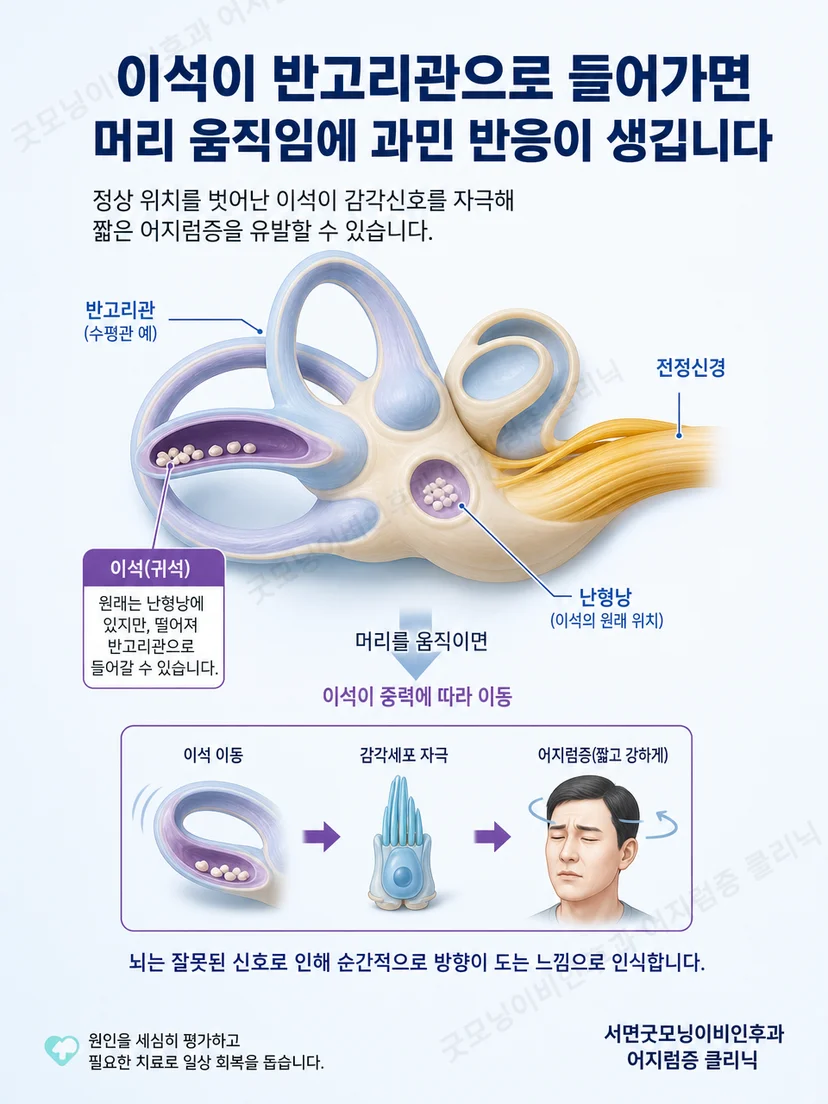 내이의 이석과 반고리관이 자세성 어지럼을 일으키는 원리 이미지