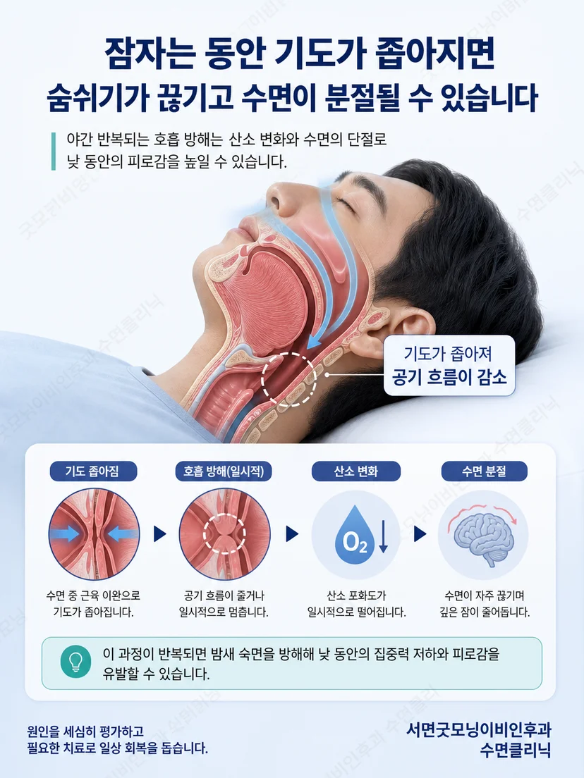 수면 중 상기도가 좁아지는 과정과 호흡 변화를 설명하는 그림