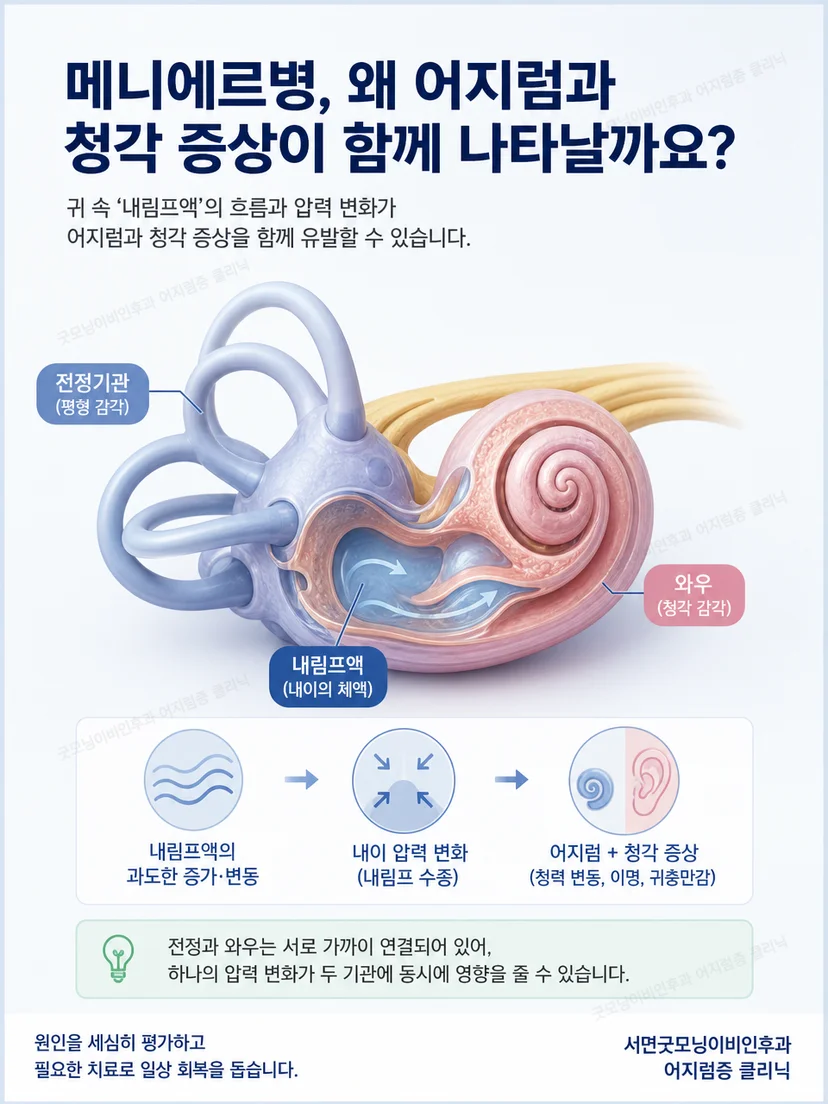 내이의 청각기관과 평형기관 및 위치성 어지럼 원리를 보여주는 이미지