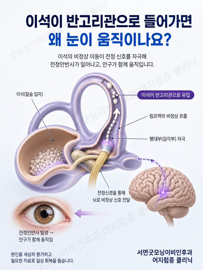 반고리관 안에서 이석이 움직여 내림프 흐름과 전정안반사를 유발하는 원리