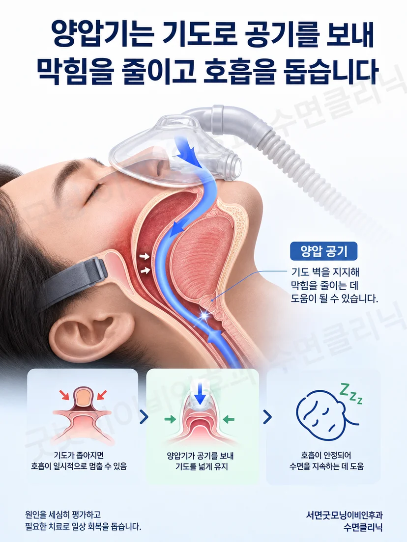 양압기 공기 흐름이 수면 중 상기도를 지지하는 원리