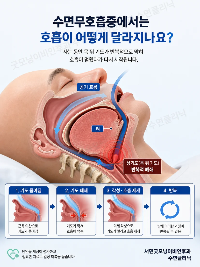 상기도 조직의 진동과 반복적인 기도 폐쇄를 설명하는 해부학 이미지
