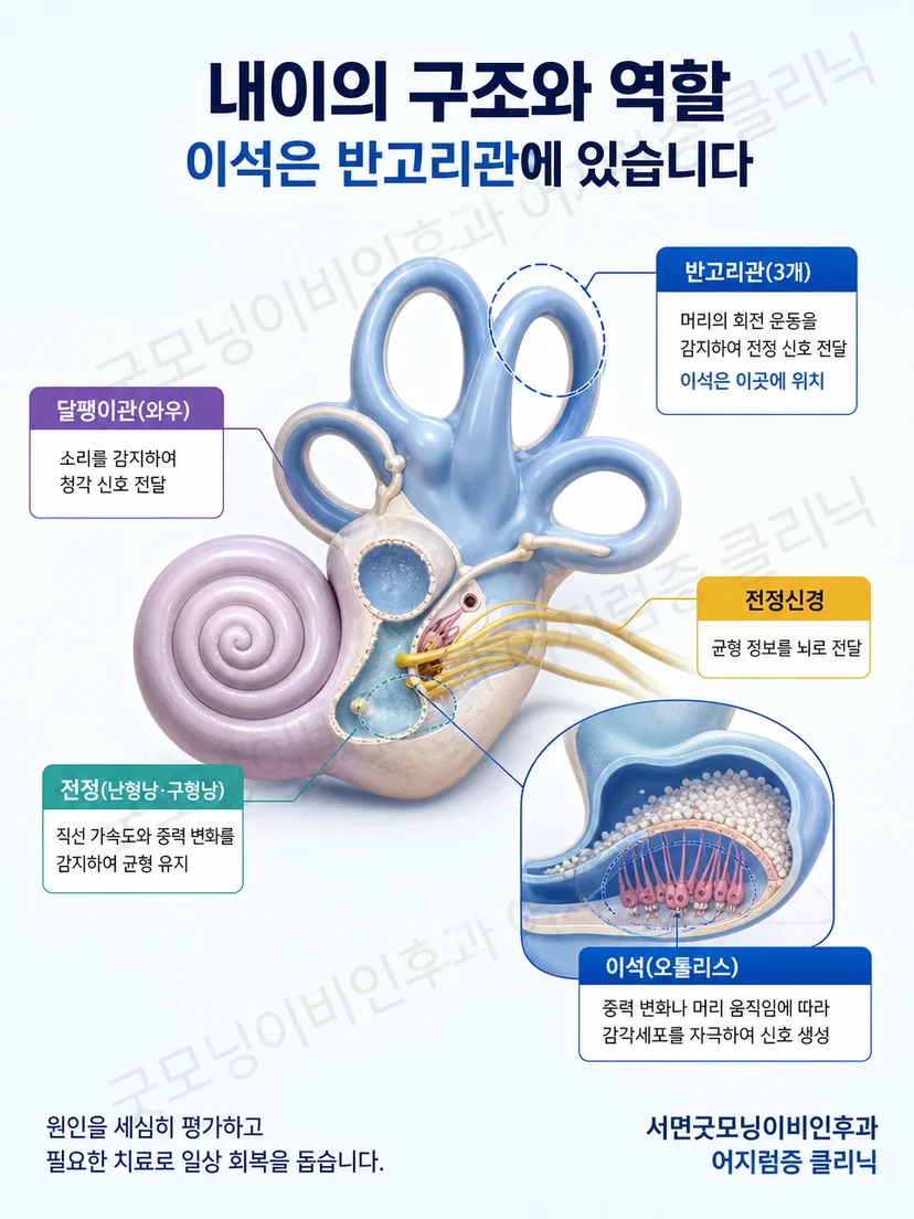 내이의 달팽이관과 전정기관 및 반고리관 속 이석 위치를 설명한 이미지