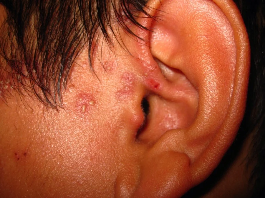singles around ear