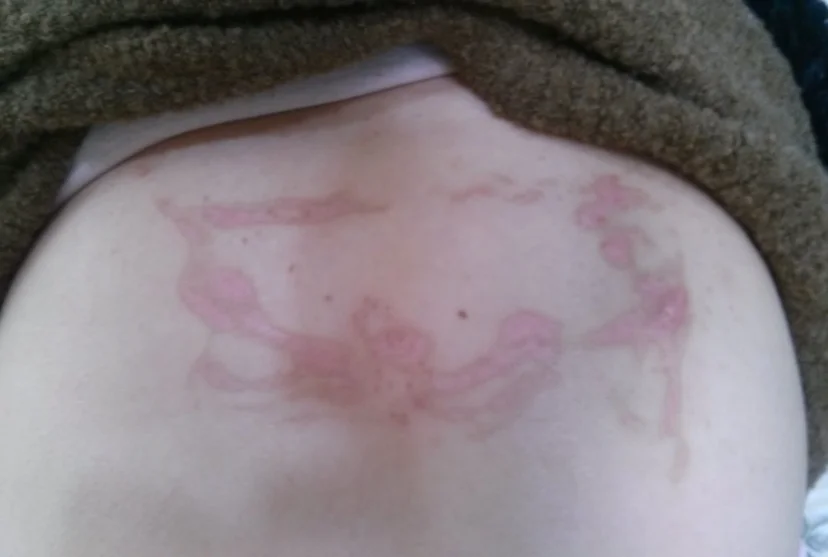 Post herpetic neuraligia on back