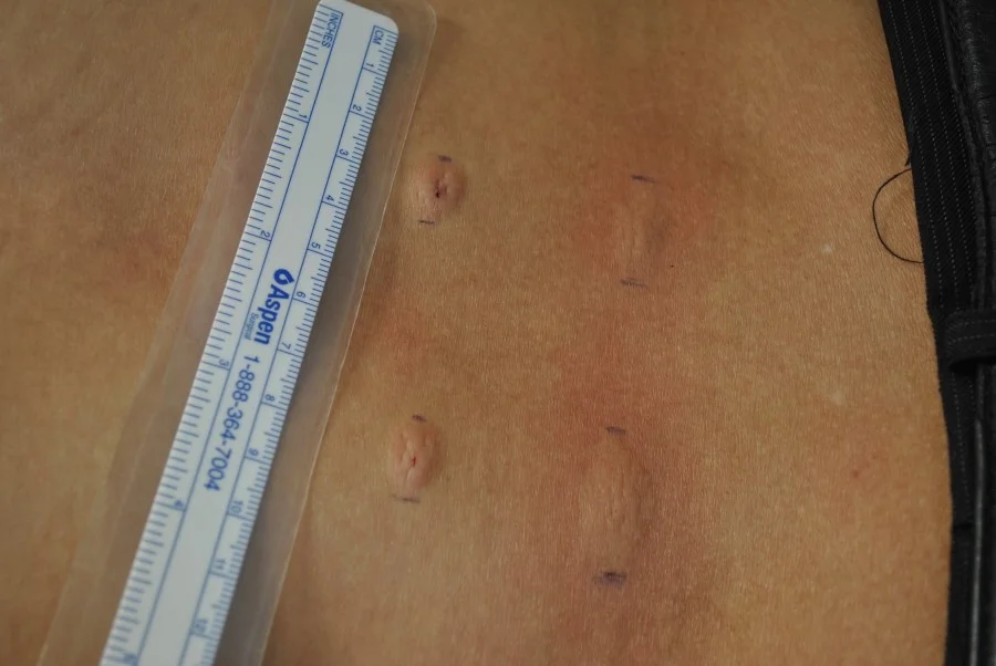 Allergic skin test of apitoxin