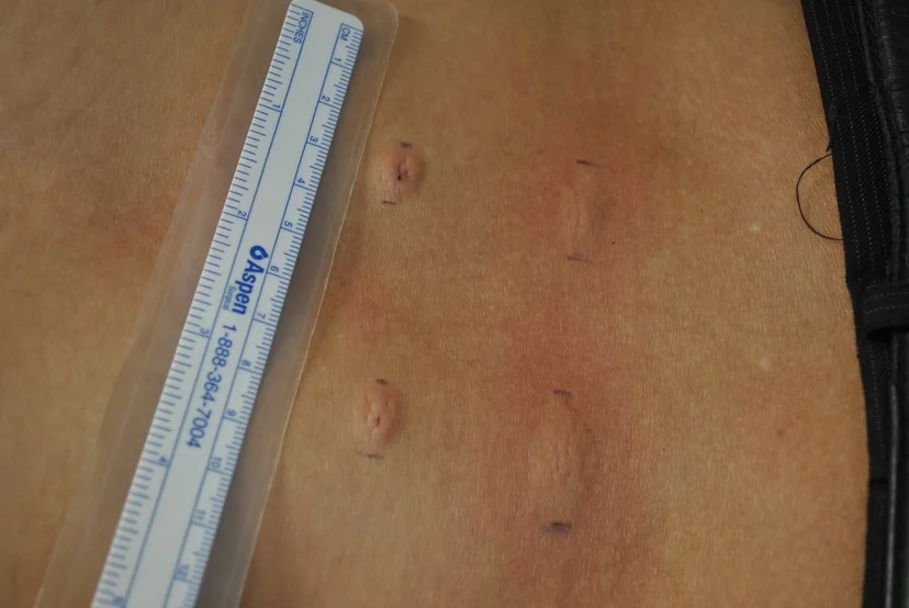 Allergic skin test of apitoxin