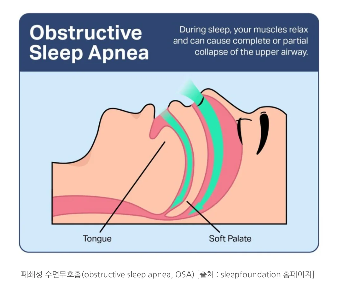 폐쇄성수면무호흡증
