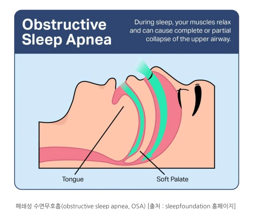 폐쇄성수면무호흡증