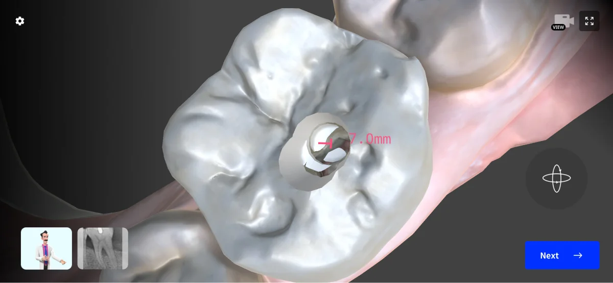 The left mandibular first molar of a 54-year-old male patient shows calcification.
