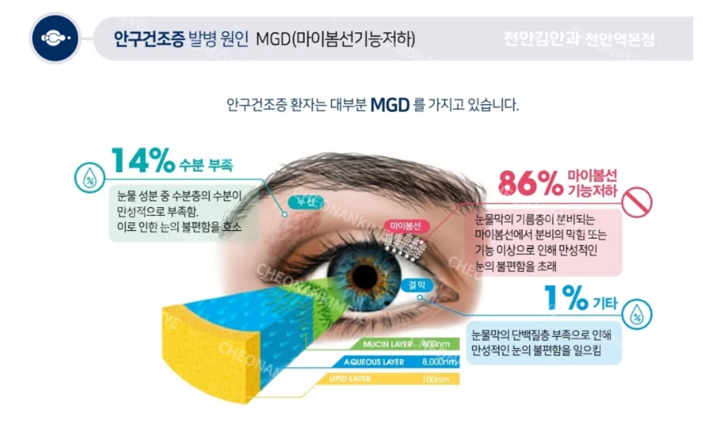 천안 안구건조증