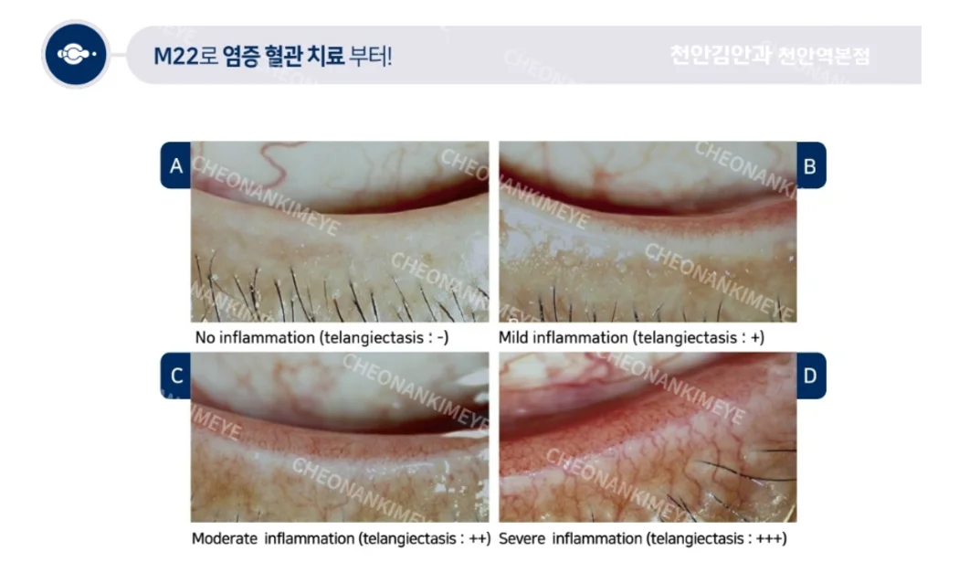 천안 안구건조증