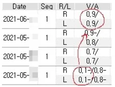 광주연세안과 드림렌즈