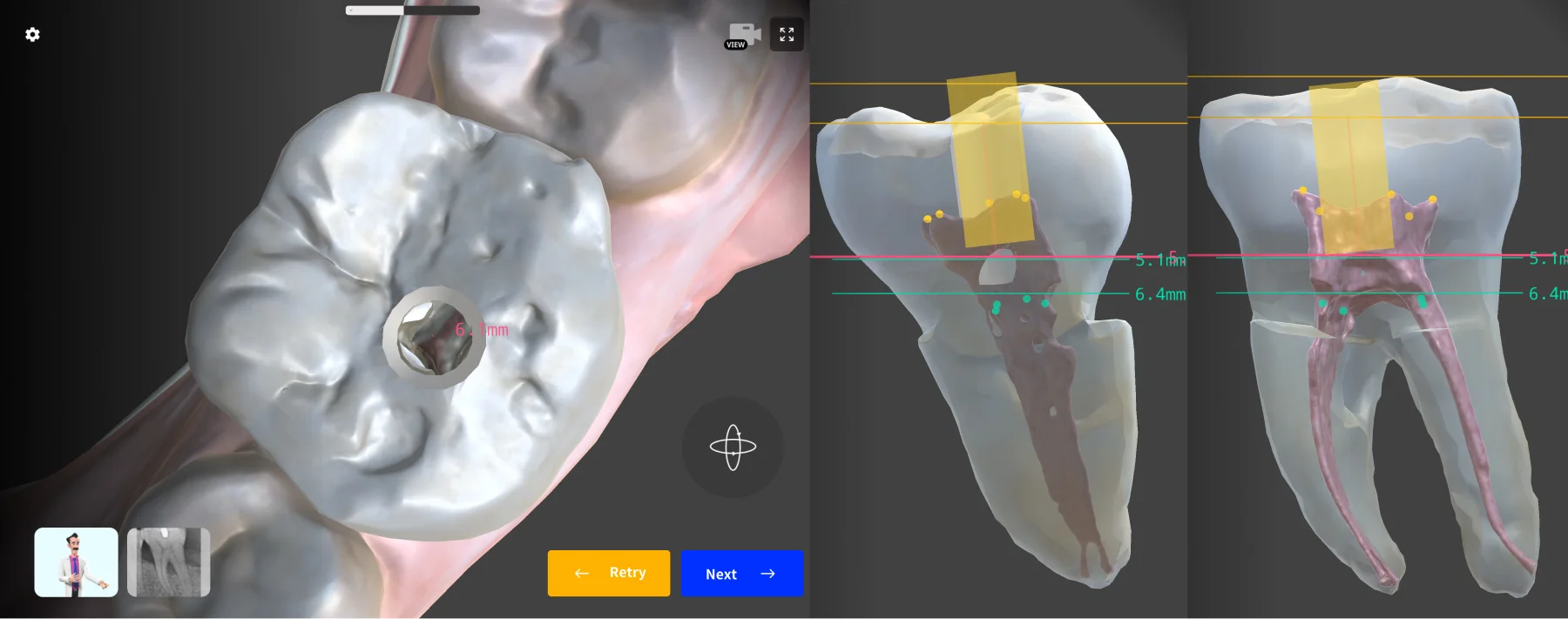 Between the Central Pit and Buccal Ridge
