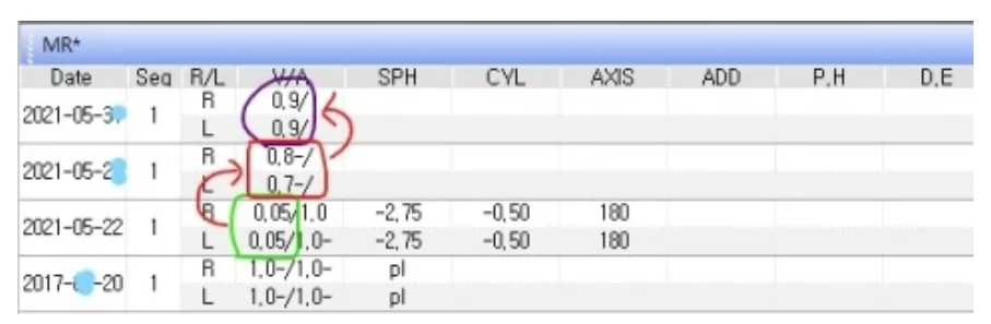 광주연세안과 드림렌즈