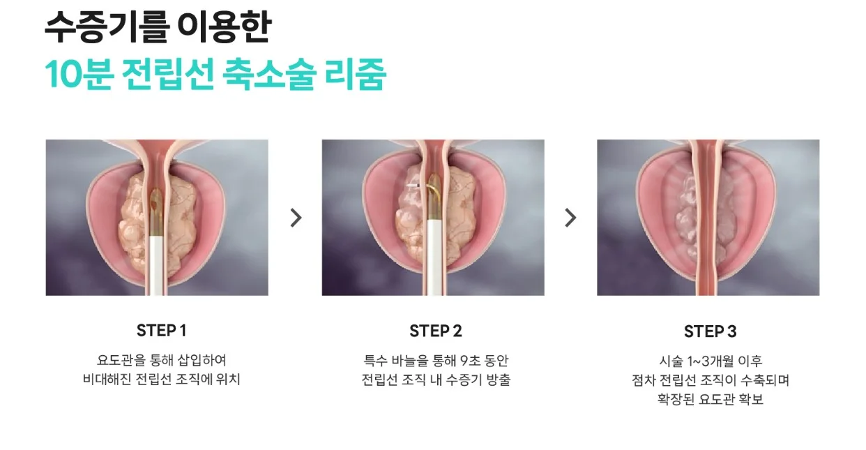 천안 리줌 수술