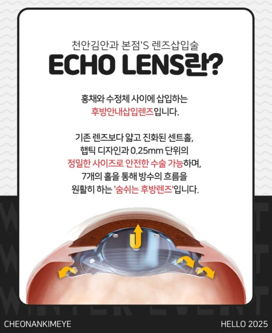 천안 안내렌즈삽입술