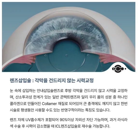 천안 안내렌즈삽입술