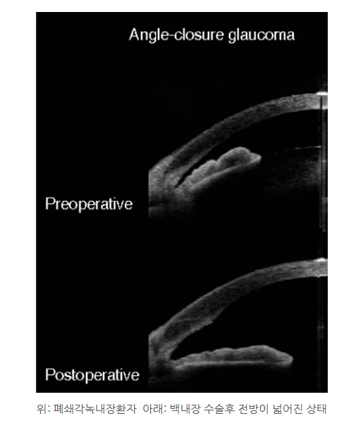 경기광주 녹내장 백내장