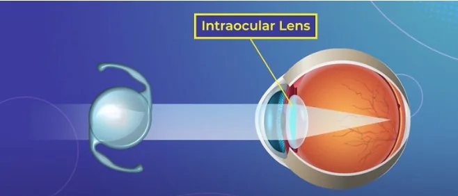 백내장의 인공수정체 필요성