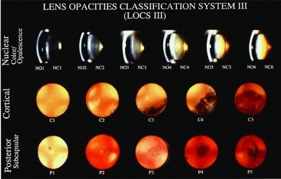 천안 백내장 수술 시기